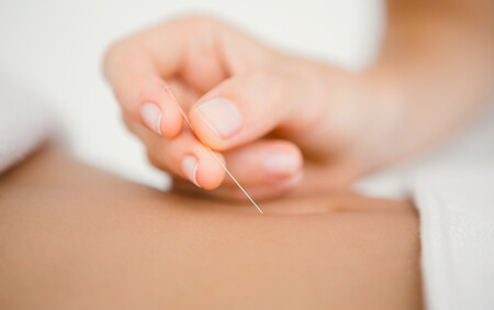 akupunktur fertilitetsbehandling
